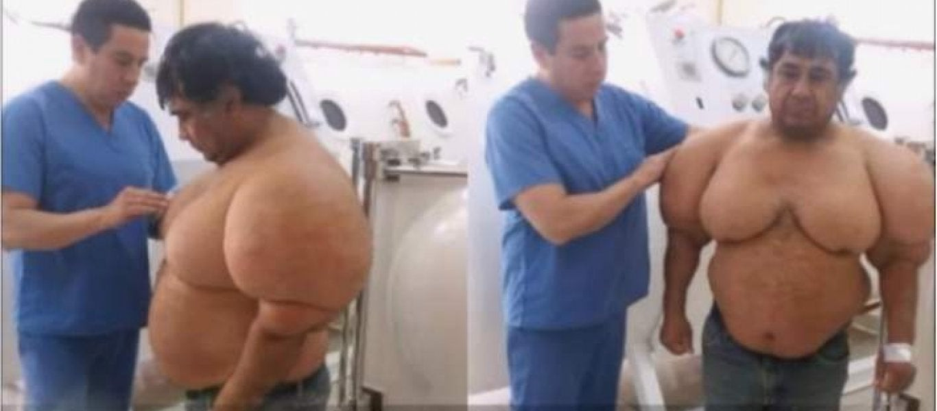 Παραμορφώθηκε ψαράς από τη νόσο του δύτη – Δείτε πως φούσκωσε σαν μπαλόνι (βίντεο)